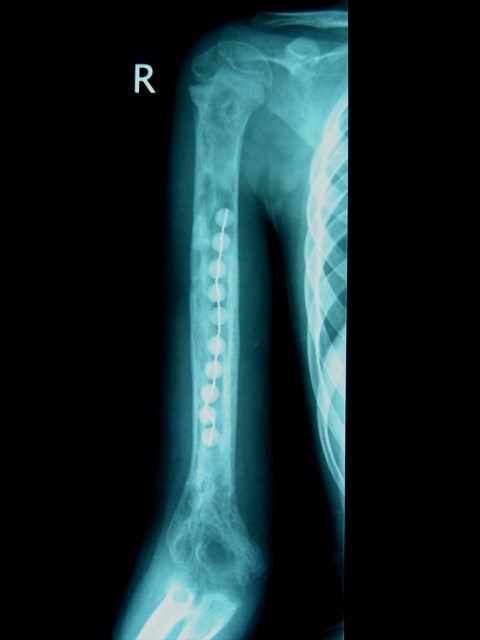 Post Operative X-Ray